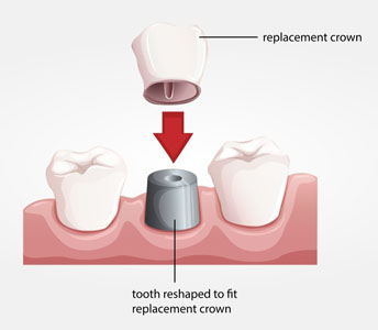 Dental Crowns