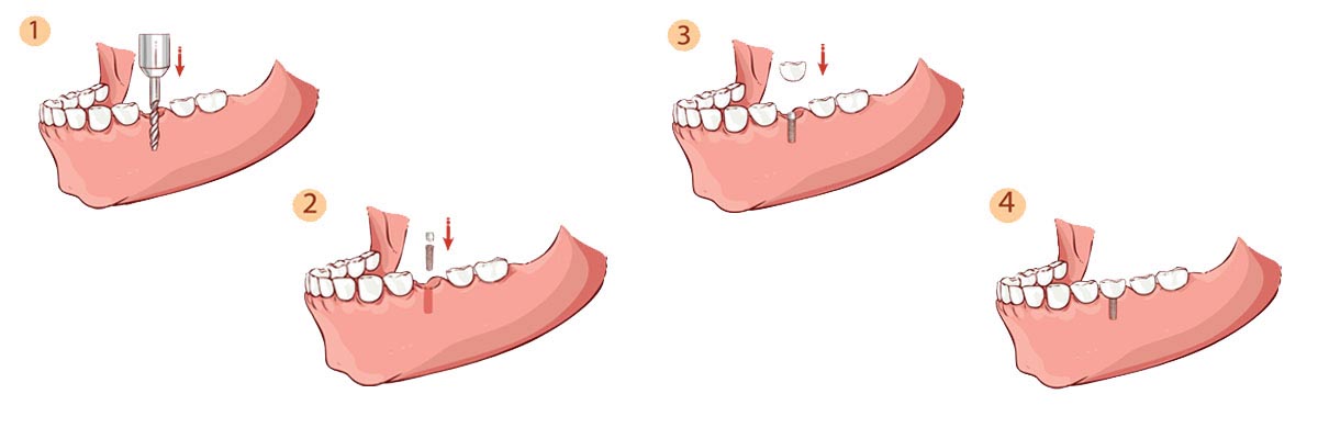 Dothan The Dental Implant Procedure