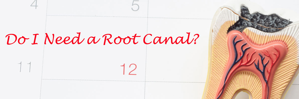 Dothan Do I Need a Root Canal