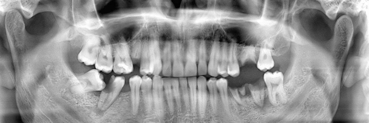 Dothan Options for Replacing Missing Teeth